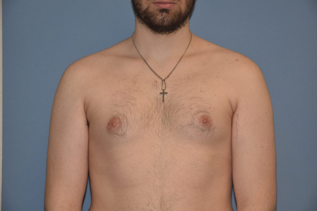Gynecomastia & Chest Masculinisation, patient 1, before, view 1