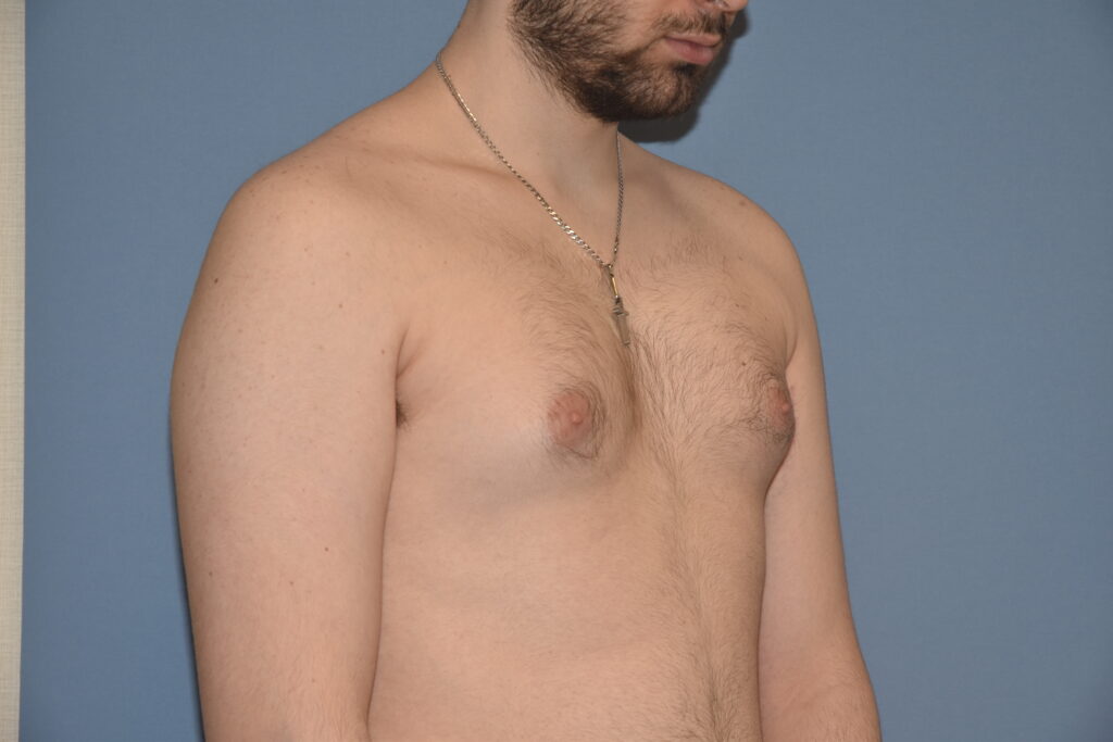 Gynecomastia & Chest Masculinisation, patient 1, before, view 2