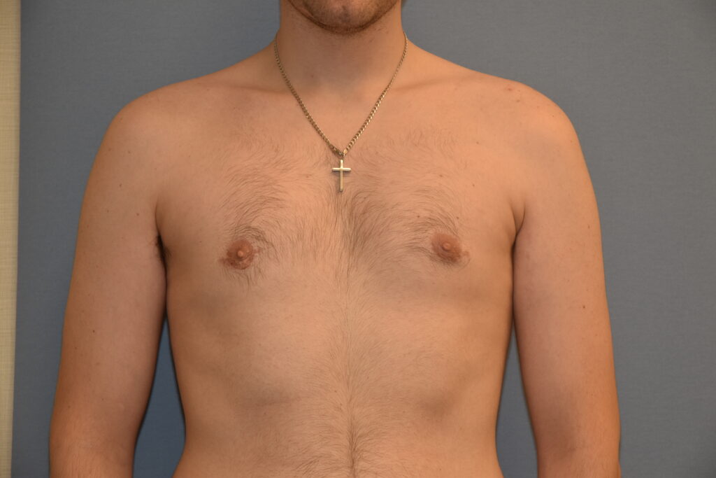Gynecomastia & Chest Masculinisation, patient 1, after, view 1