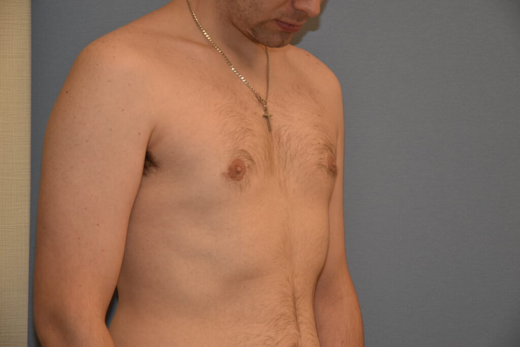Gynecomastia & Chest Masculinisation, patient 1, after, view 2