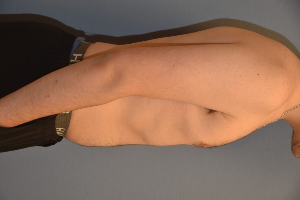 Gynecomastia & Chest Masculinisation, patient 1, after, view 3