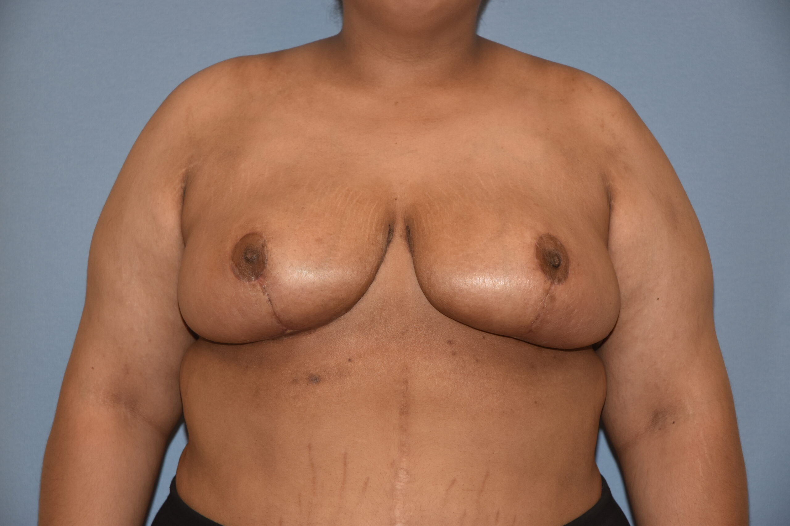 Breast Reduction result — placeholder image
