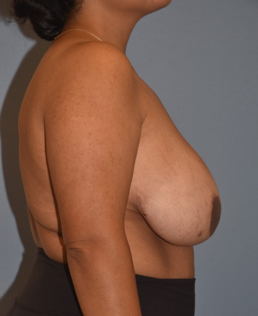 Revision Breast Surgery, patient 2, before, view 3