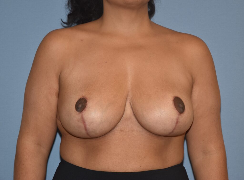 Revision Breast Surgery, patient 2, after, view 1