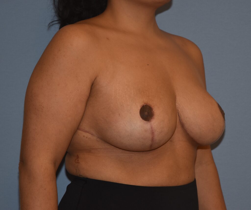 Revision Breast Surgery, patient 2, after, view 2
