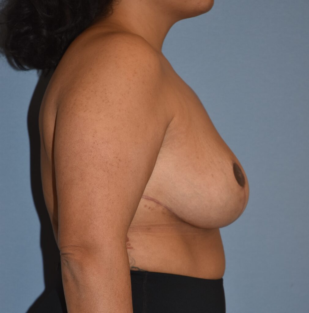 Revision Breast Surgery, patient 2, after, view 3