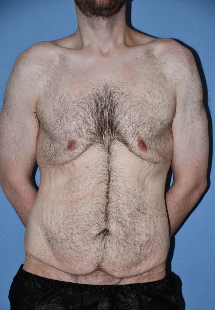 Belt Lipectomy, patient 1, before, view 1