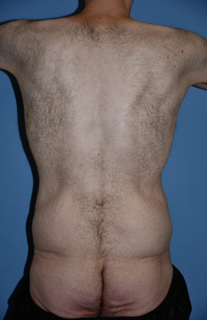 Belt Lipectomy, patient 1, before, view 10