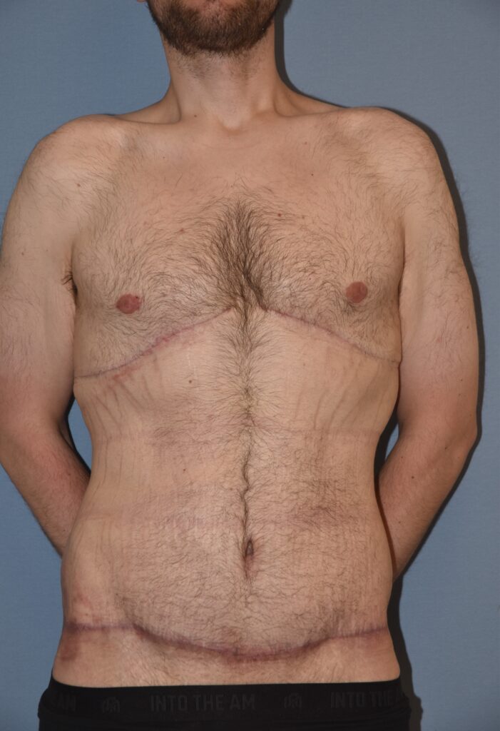 Belt Lipectomy, patient 1, after, view 1