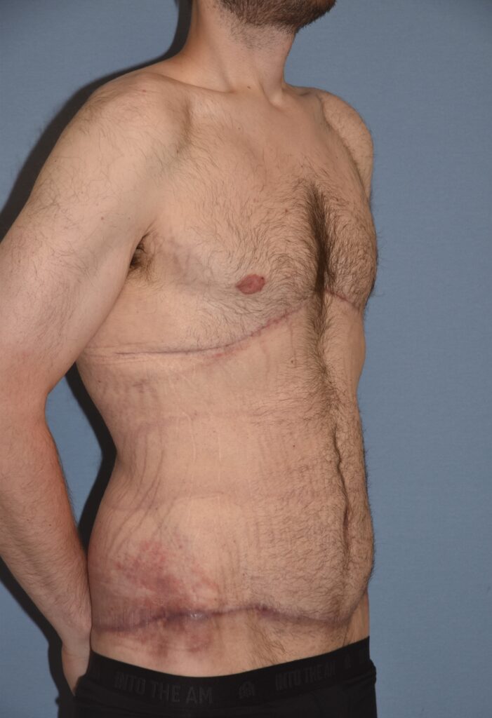Belt Lipectomy, patient 1, after, view 2