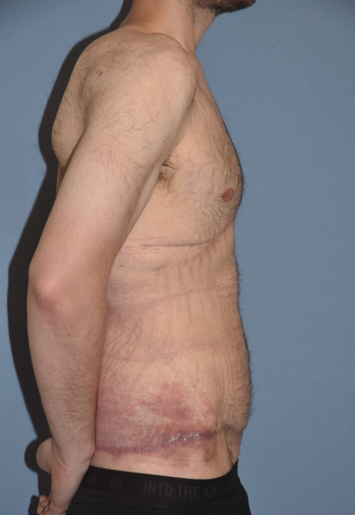 Belt Lipectomy, patient 1, after, view 3