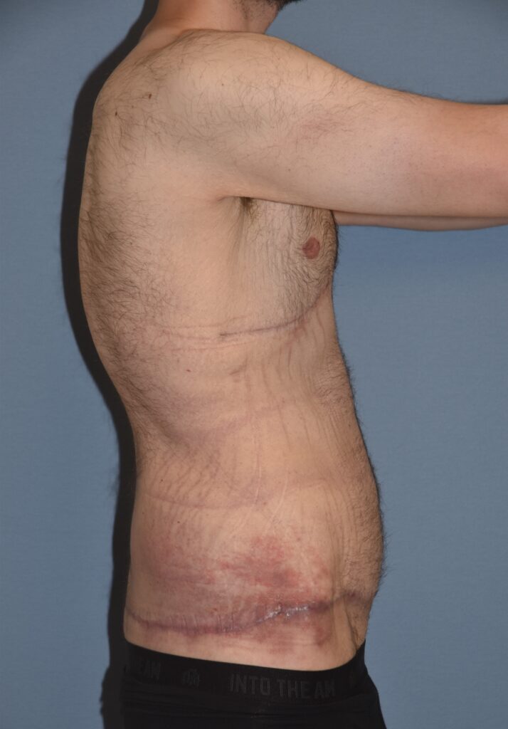 Belt Lipectomy, patient 1, after, view 4