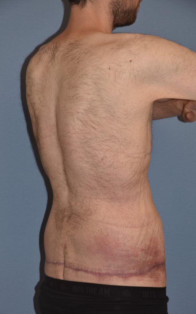 Belt Lipectomy, patient 1, after, view 5