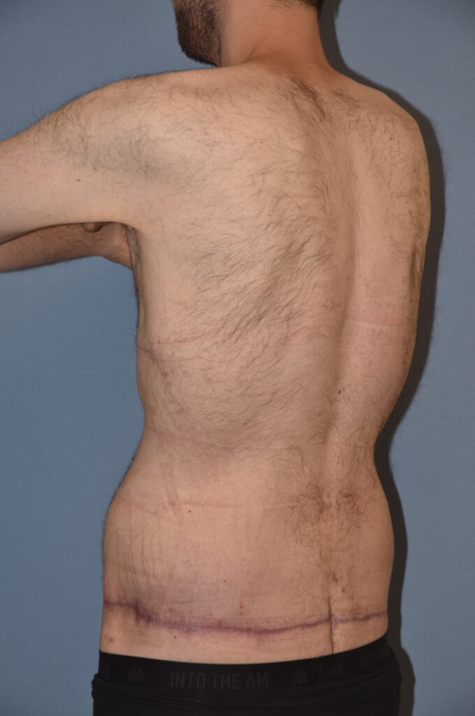 Belt Lipectomy, patient 1, after, view 6