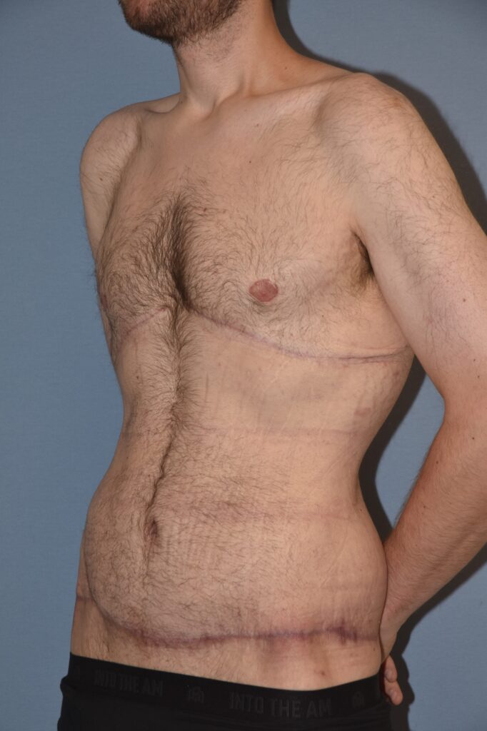 Belt Lipectomy, patient 1, after, view 7