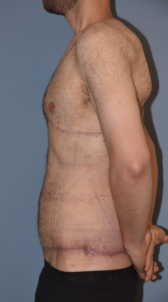 Belt Lipectomy, patient 1, after, view 8