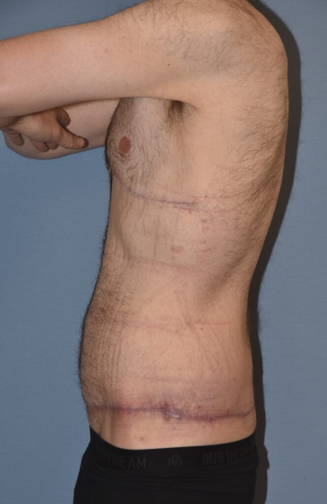 Belt Lipectomy, patient 1, after, view 9