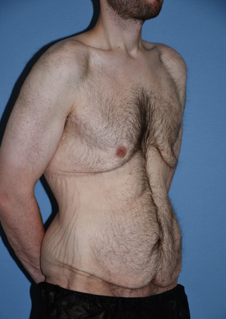 Belt Lipectomy, patient 1, before, view 2