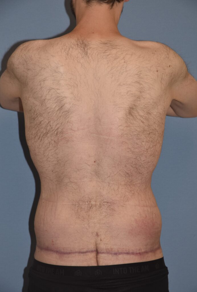 Belt Lipectomy, patient 1, after, view 10