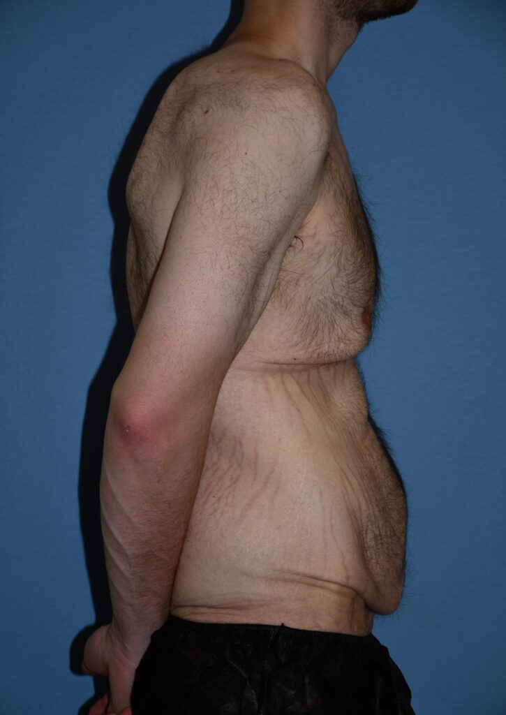 Belt Lipectomy, patient 1, before, view 3