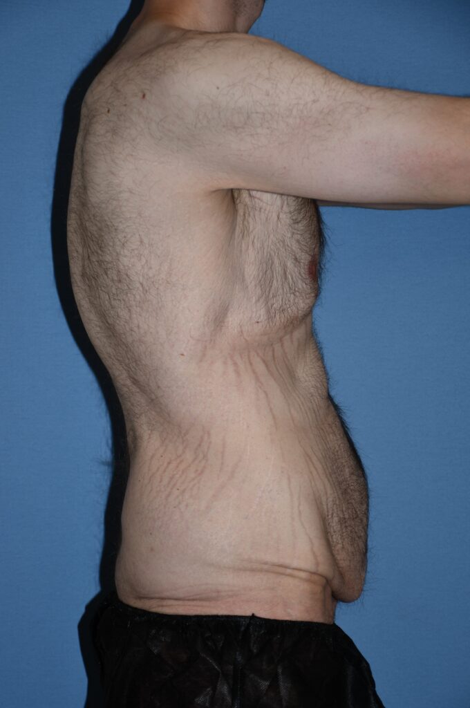 Belt Lipectomy, patient 1, before, view 4