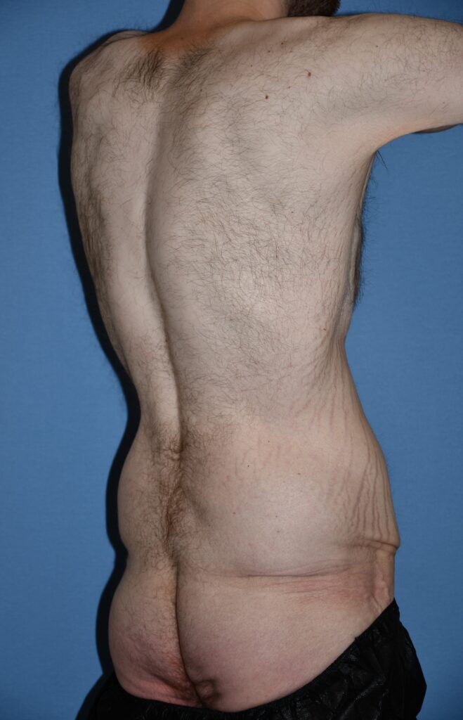 Belt Lipectomy, patient 1, before, view 5