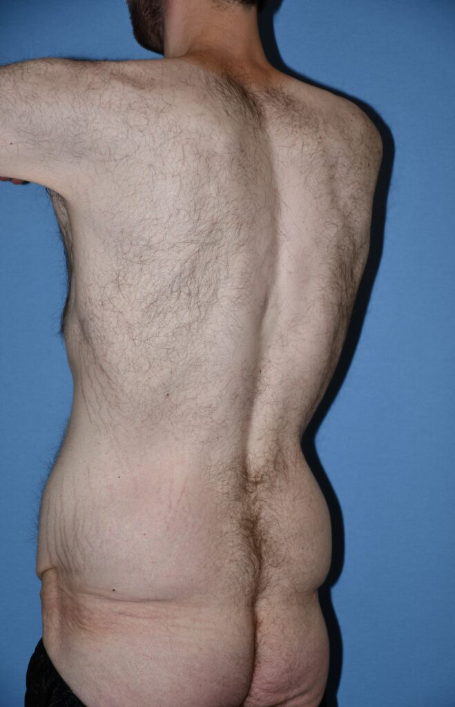 Belt Lipectomy, patient 1, before, view 6