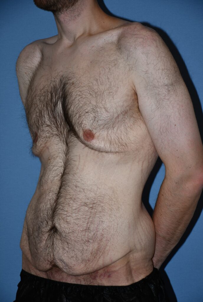 Belt Lipectomy, patient 1, before, view 7