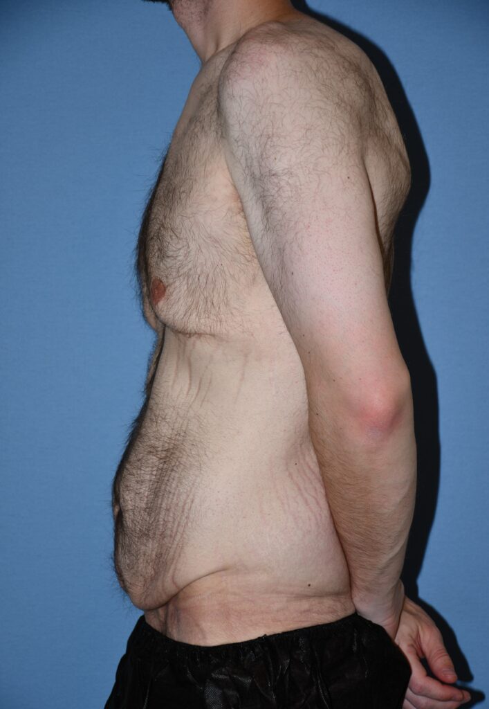 Belt Lipectomy, patient 1, before, view 8