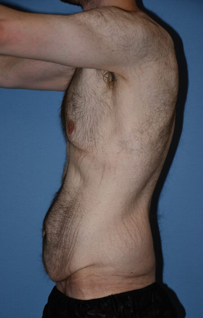 Belt Lipectomy, patient 1, before, view 9