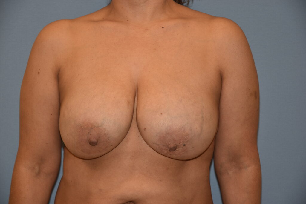 Revision Breast Surgery, patient 1, before, view 1
