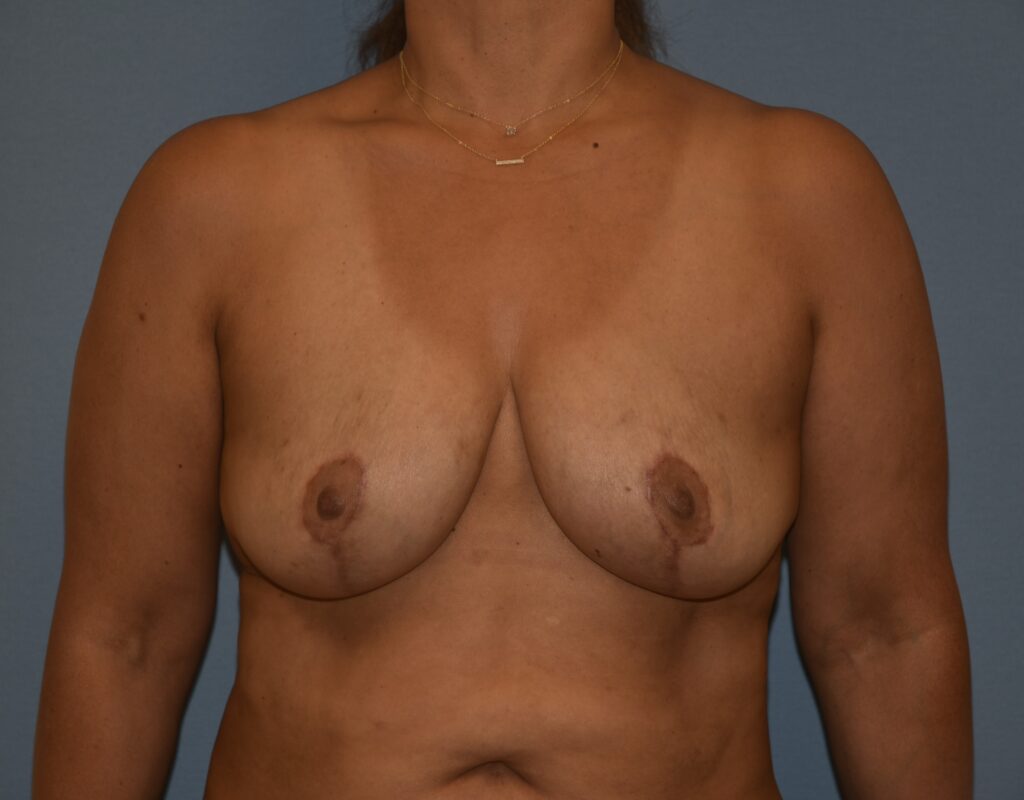 Revision Breast Surgery, patient 1, after, view 1