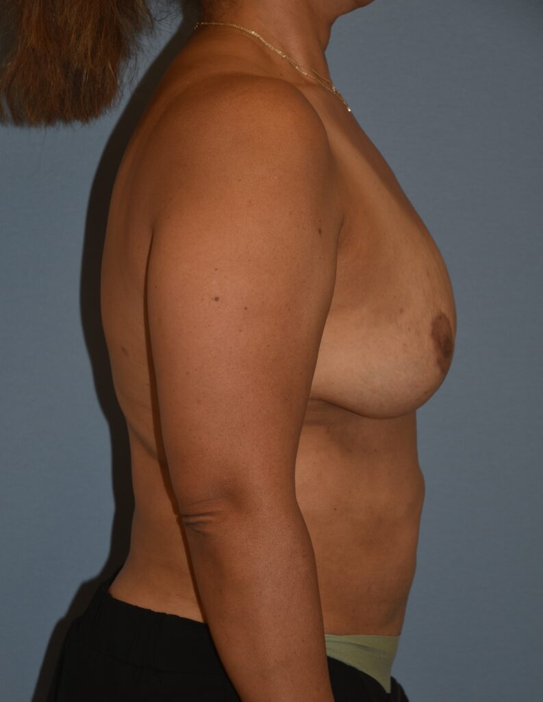 Revision Breast Surgery, patient 1, after, view 3