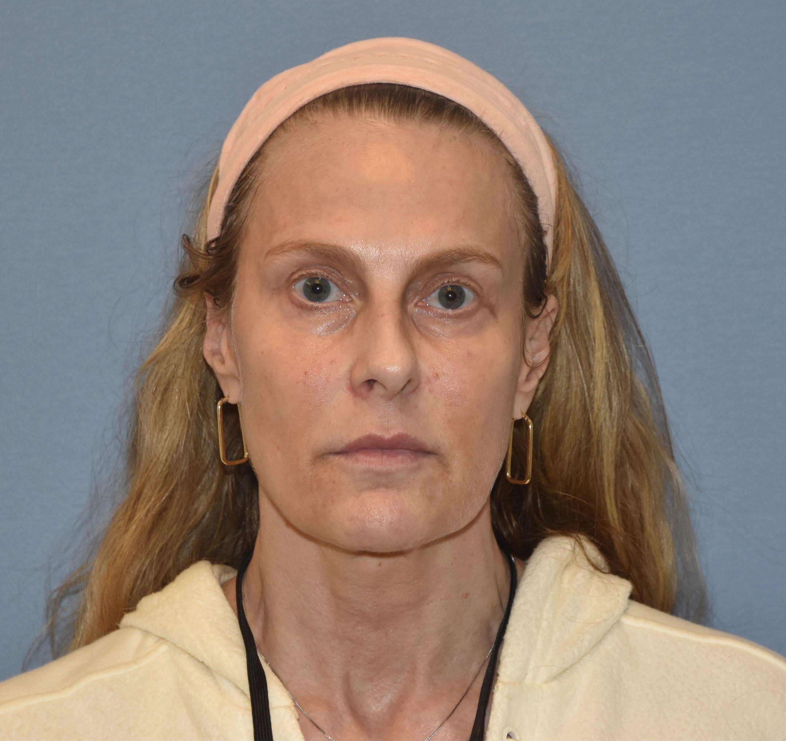 Facial Fat Grafting result — placeholder image