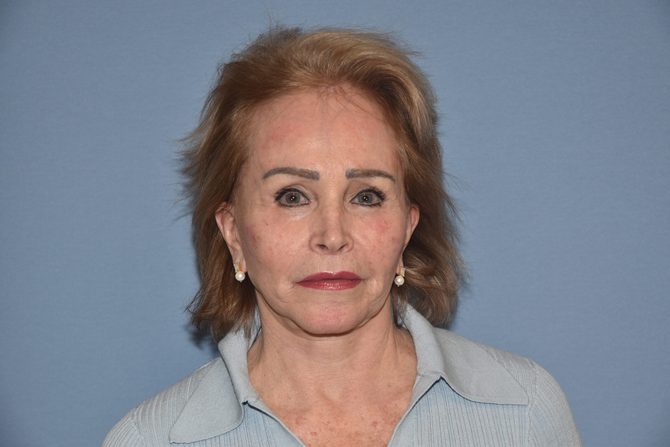 Facial Surgery result — placeholder image