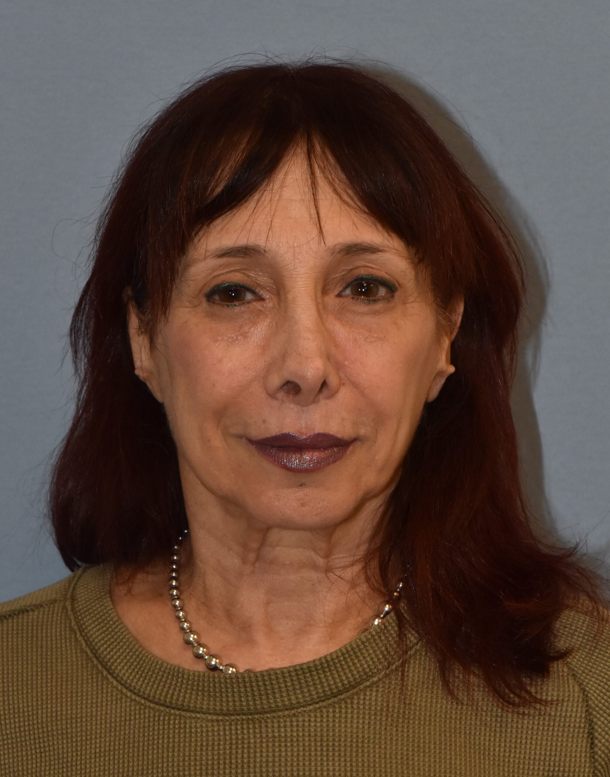 Facial Surgery result — placeholder image