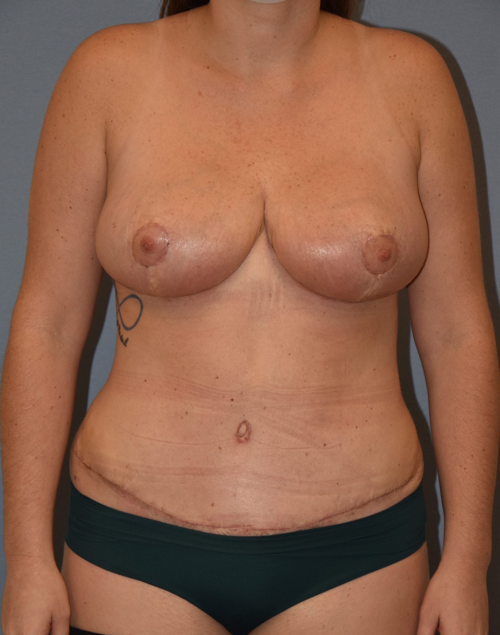 Body Contouring result — placeholder image