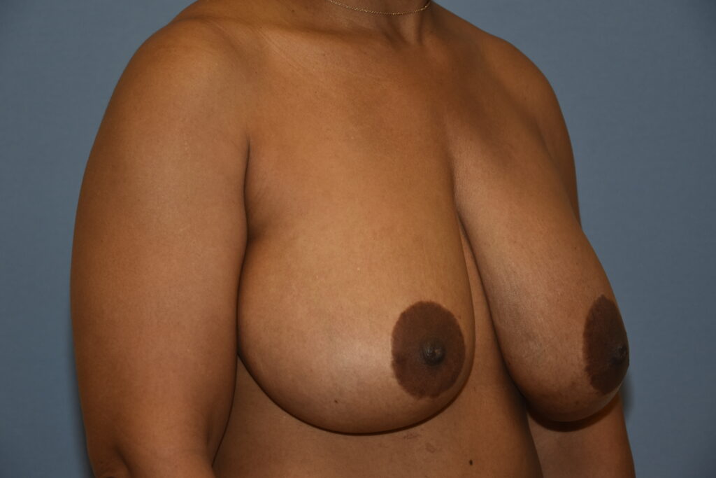Revision Breast Surgery, patient 4, before, view 2