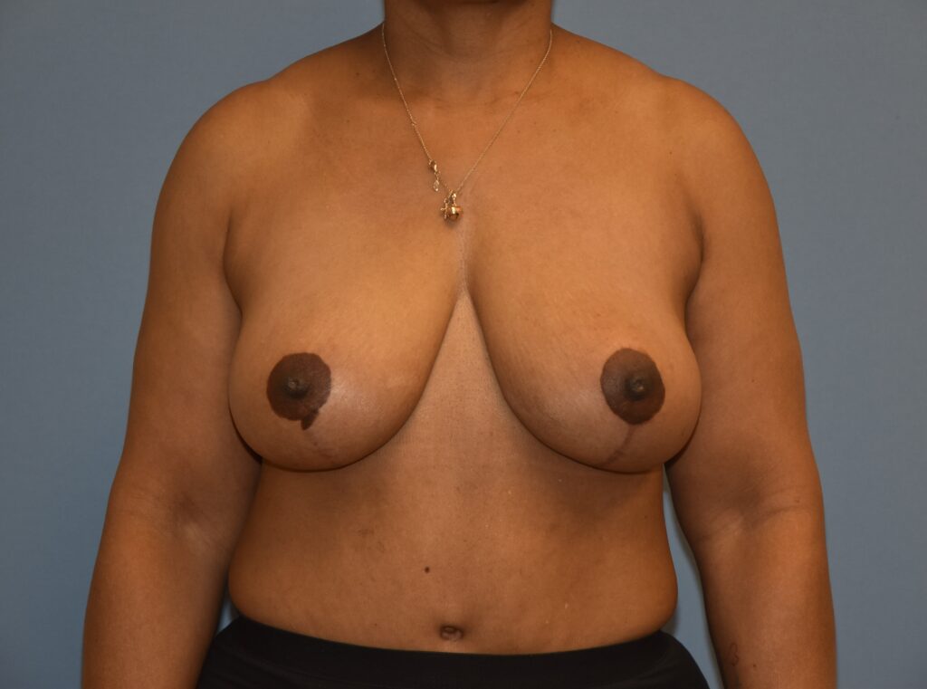 Revision Breast Surgery, patient 4, after, view 1