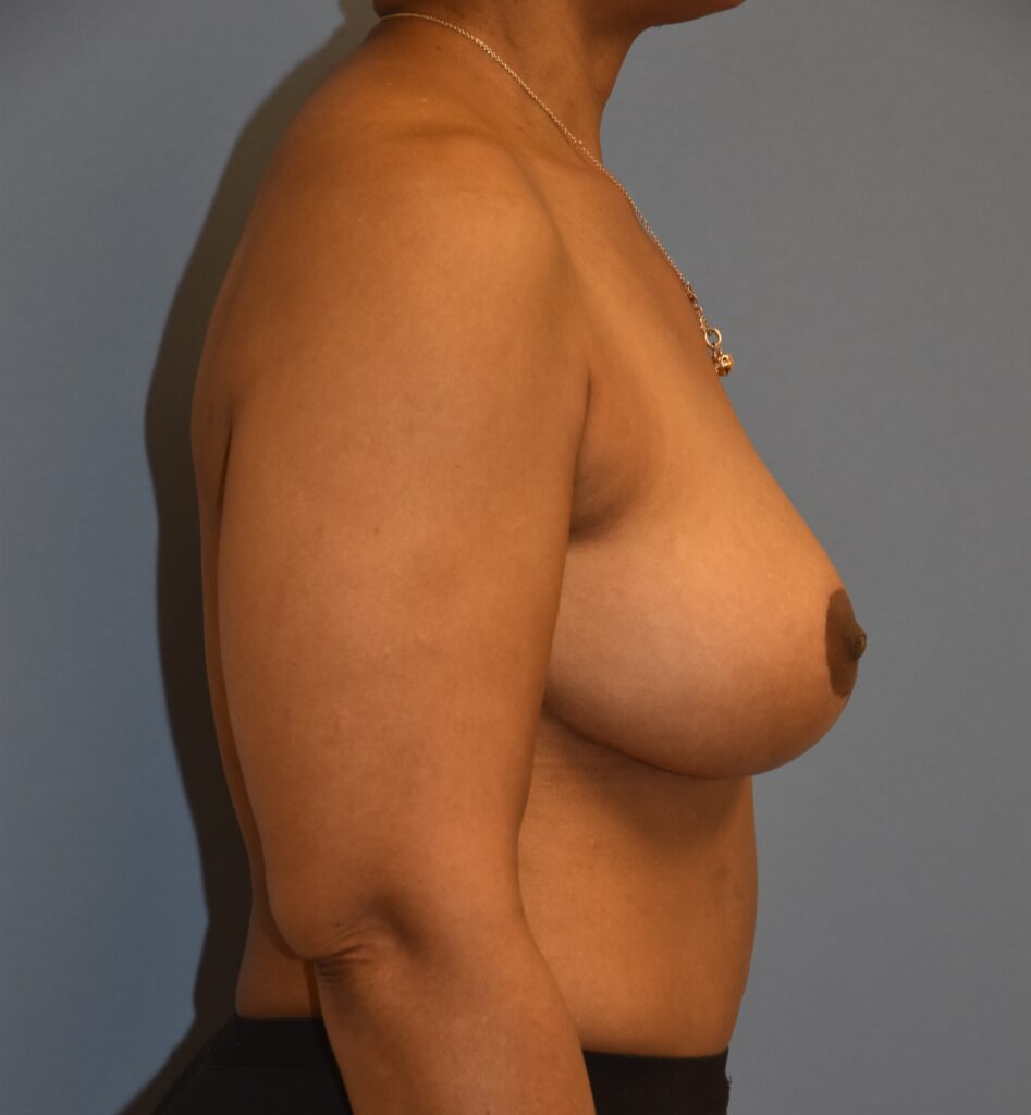 Revision Breast Surgery, patient 4, after, view 3