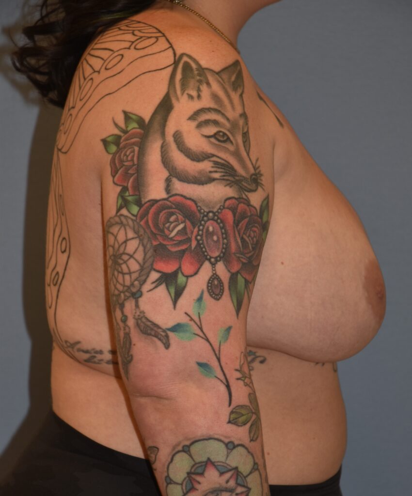 Revision Breast Surgery, patient 3, before, view 3