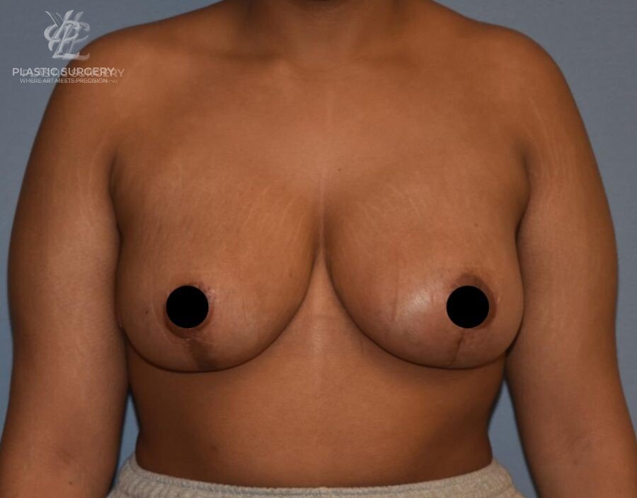 Augmentation Mastopexy, patient 1, after, view 1