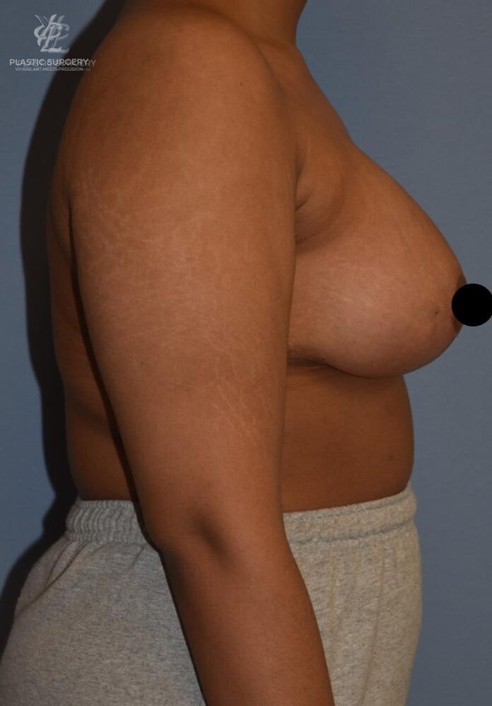 Augmentation Mastopexy, patient 1, after, view 3