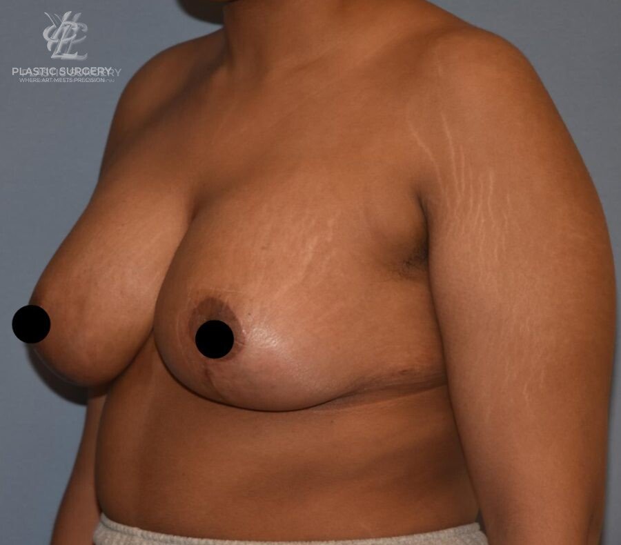 Augmentation Mastopexy, patient 1, after, view 2