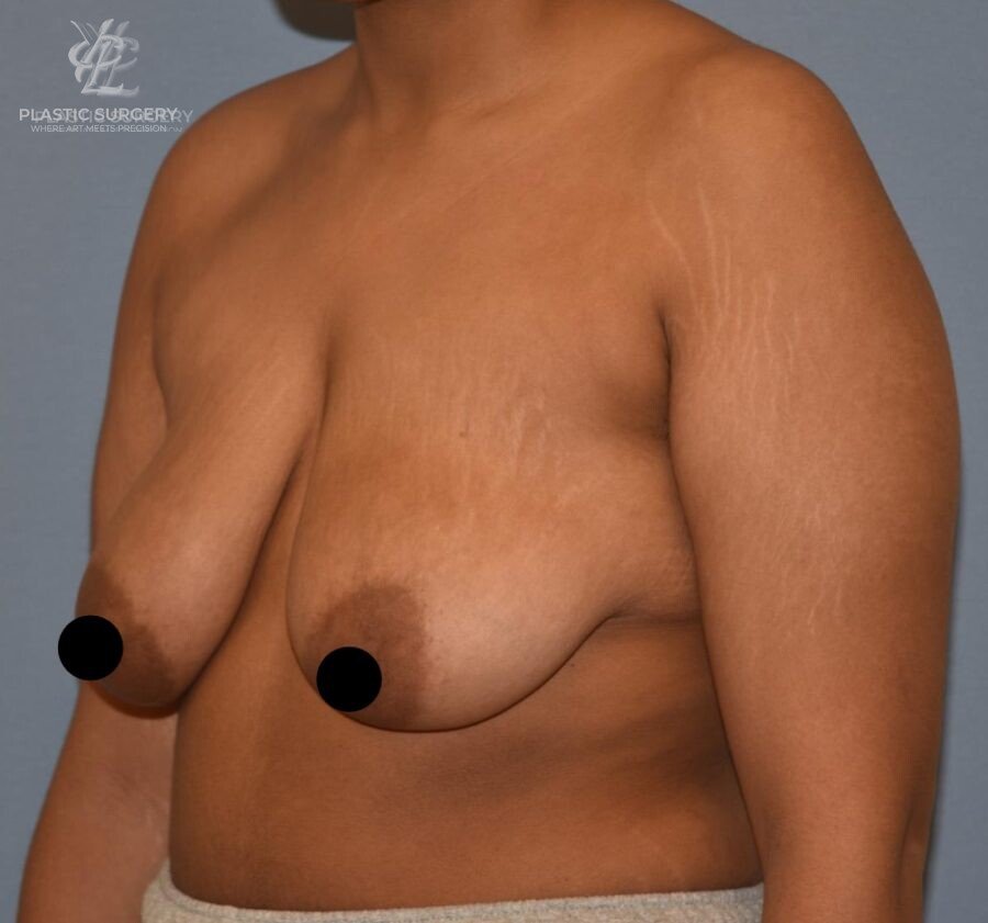 Augmentation Mastopexy, patient 1, before, view 2