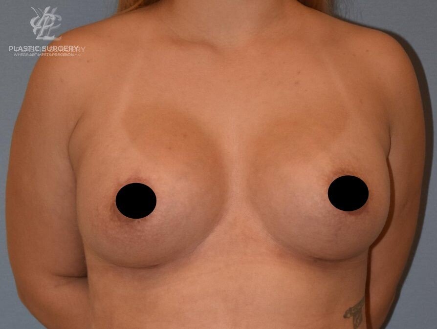 Augmentation Mastopexy, patient 2, after, view 1