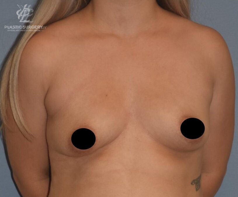 Augmentation Mastopexy, patient 2, before, view 1