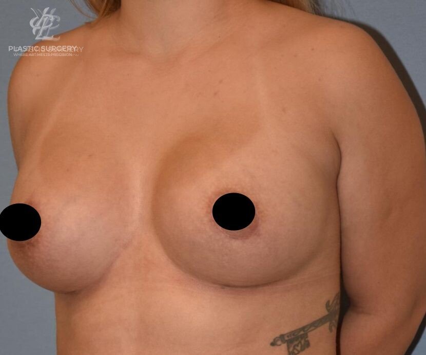 Augmentation Mastopexy, patient 2, after, view 2