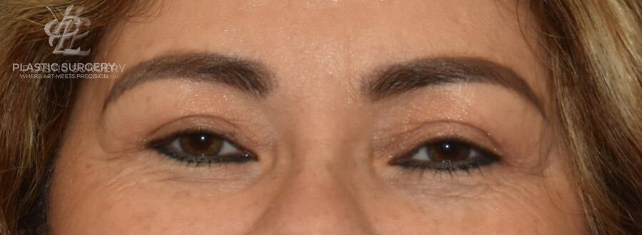 Blepharoplasty (Eyelid Surgery), patient 1, after, view 1