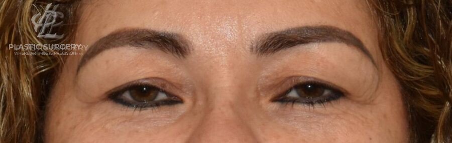 Blepharoplasty (Eyelid Surgery), patient 1, before, view 1